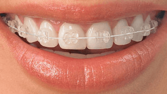 How Much are Braces?  Prices for All Brace Types in the UK