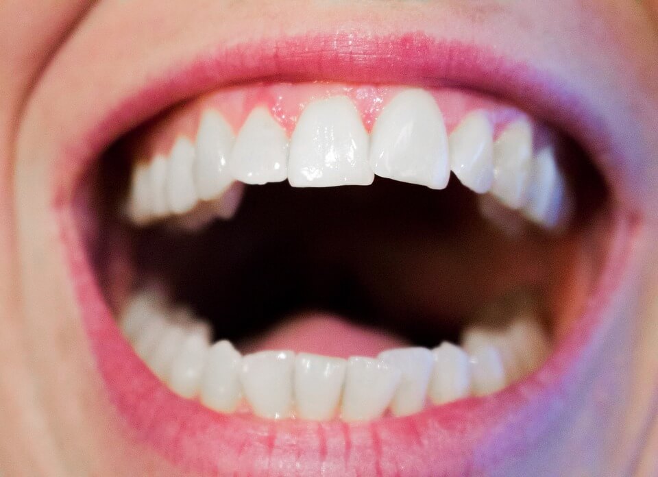 Crooked Teeth  Causes, Treatments and Problems They Cause