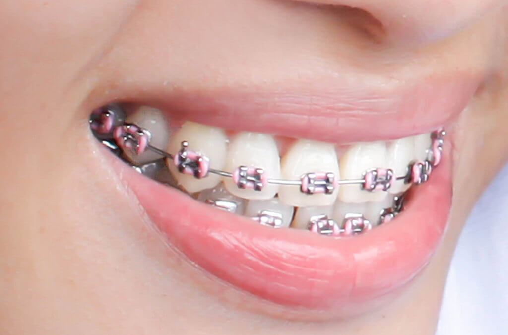 If You Wear Braces, Here's How to Brush Your Teeth