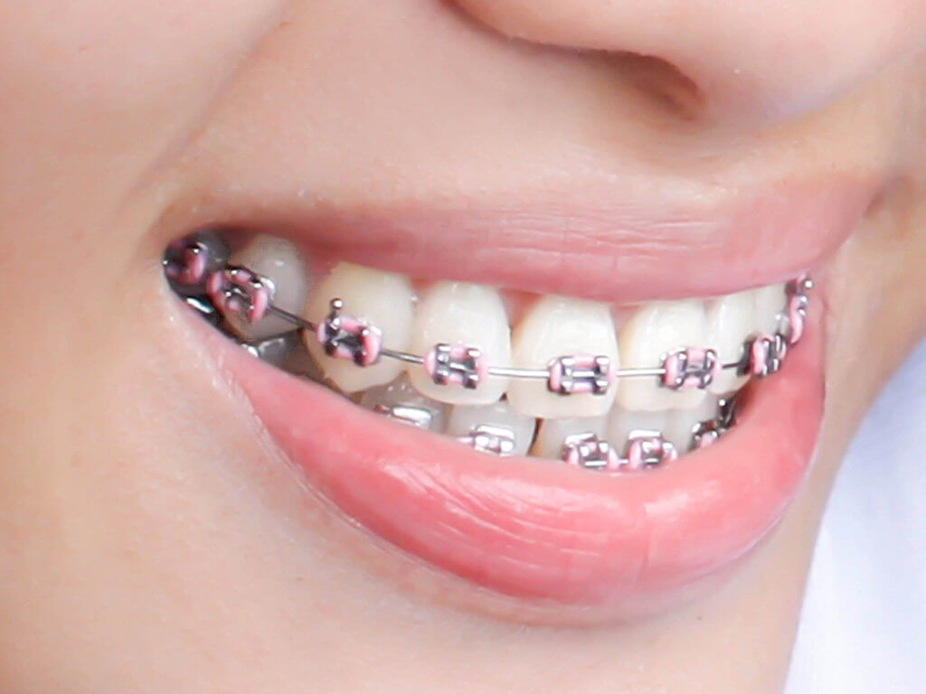 All You Need to Know About Dental Braces - Hove Dental Clinic