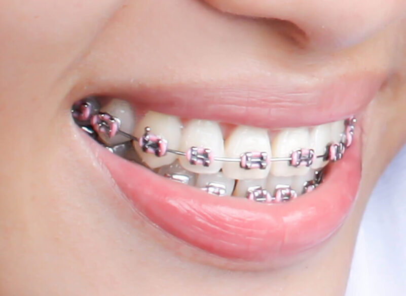 Dental Braces