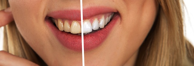 Exploring the Safety of Teeth Whitening Kits