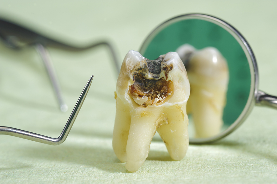 severe molar decay