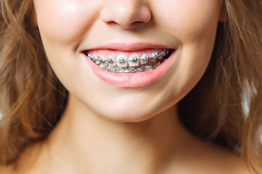 Types of Braces Used in Orthodontics [5 Best Choice]