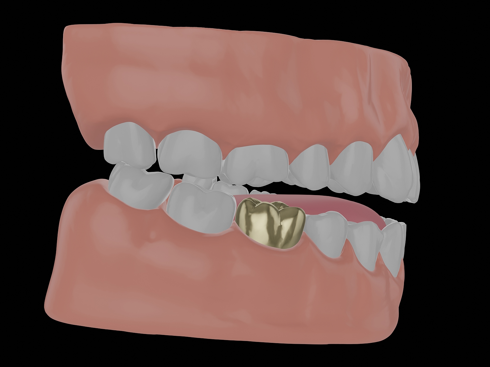 What Is A Gold Tooth Crown And What Are The Benefits