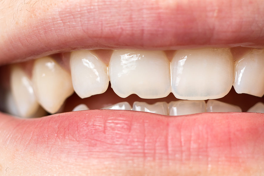 Do you have a Chipped or Cracked Tooth? Learn about the treatment