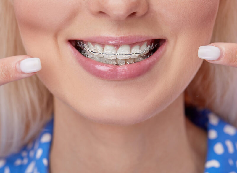 a blonde woman smiling while wearing clear bracket braces on her teeth
