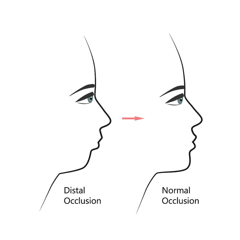 Slight Overbite Model What is an Overbite? Causes, Symptoms and Treatment