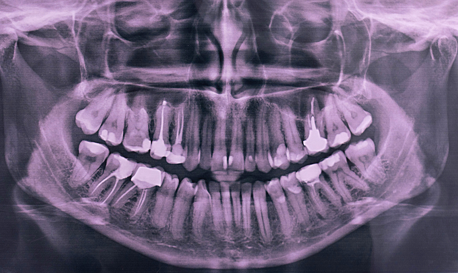 dental calculus x ray