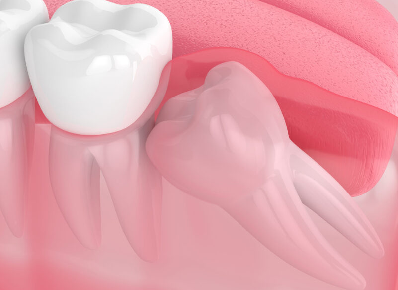 blog thumb - Hove Dental Clinic