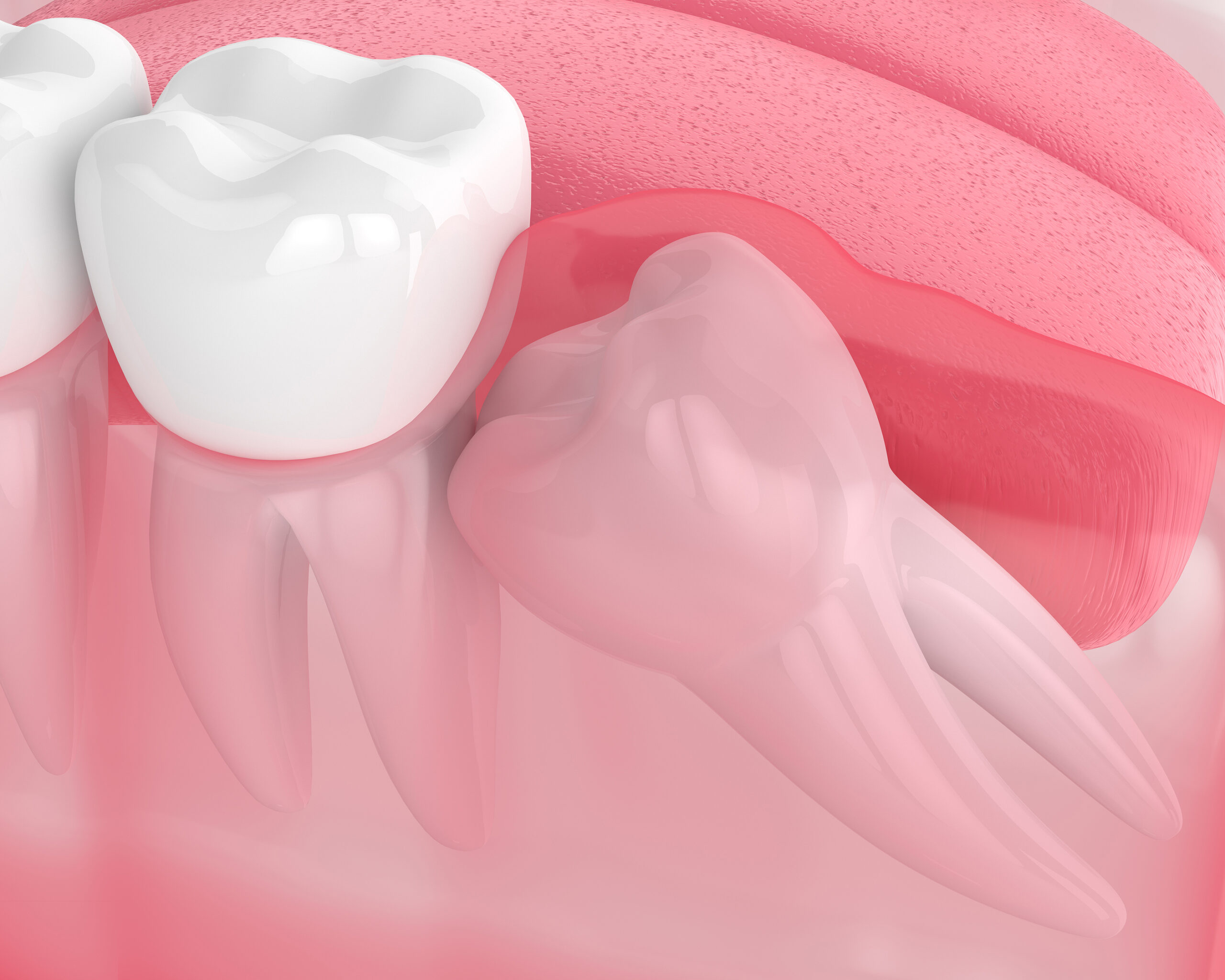 Impacted Tooth Advice On Symptoms Causes And Treatment