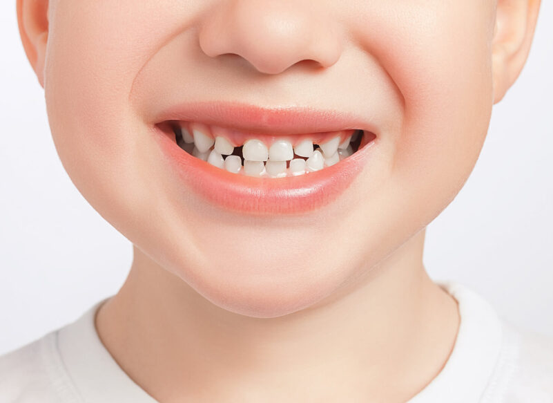 blog thumb - Hove Dental Clinic