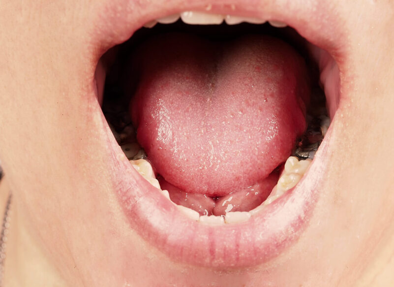 Decayed tooth root canal treatment. Tooth or teeth decay of lower molar. Restoration with a composite filling. Adult caries. bad teeth. Dental temporary restorative material. Dental concept. close up.