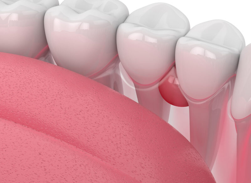 3d Render Of Teeth In Gums With Cyst Over White Background. Dent