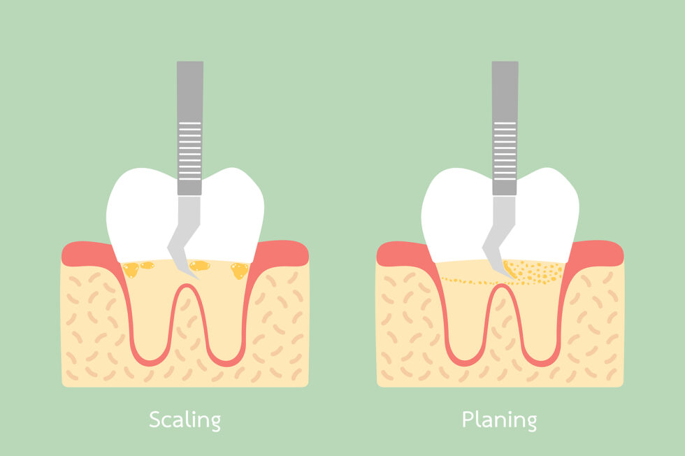 Dental Scaling Procedure Hygiene Benefits Types Of Deep Scaling And Costs