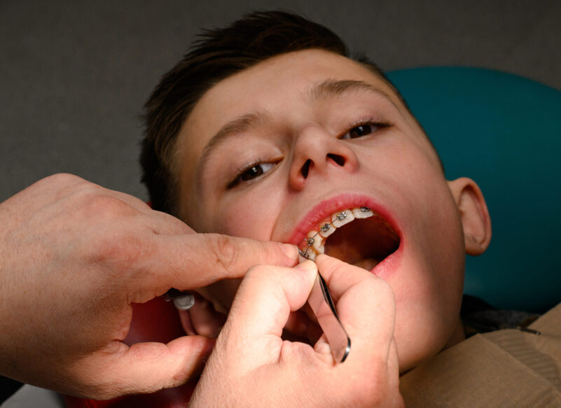 blog thumb - Hove Dental Clinic