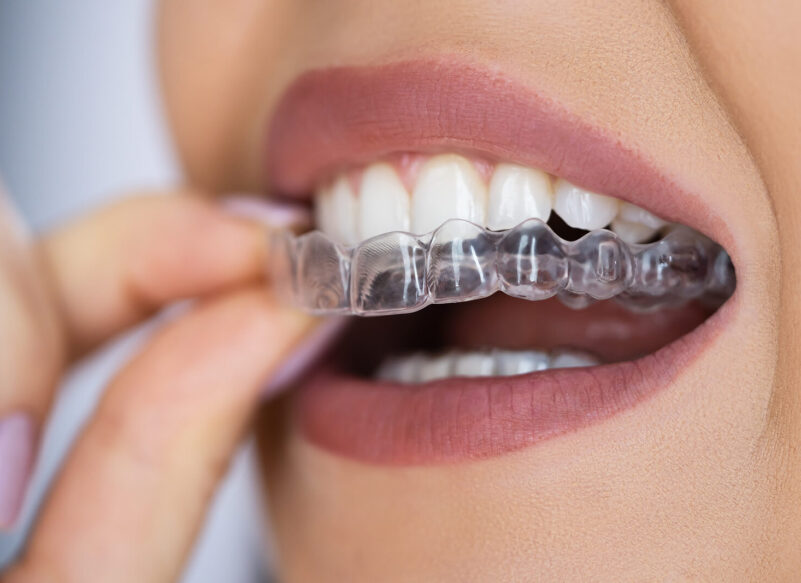 Clear Aligner Dental Night Guard For Teeth