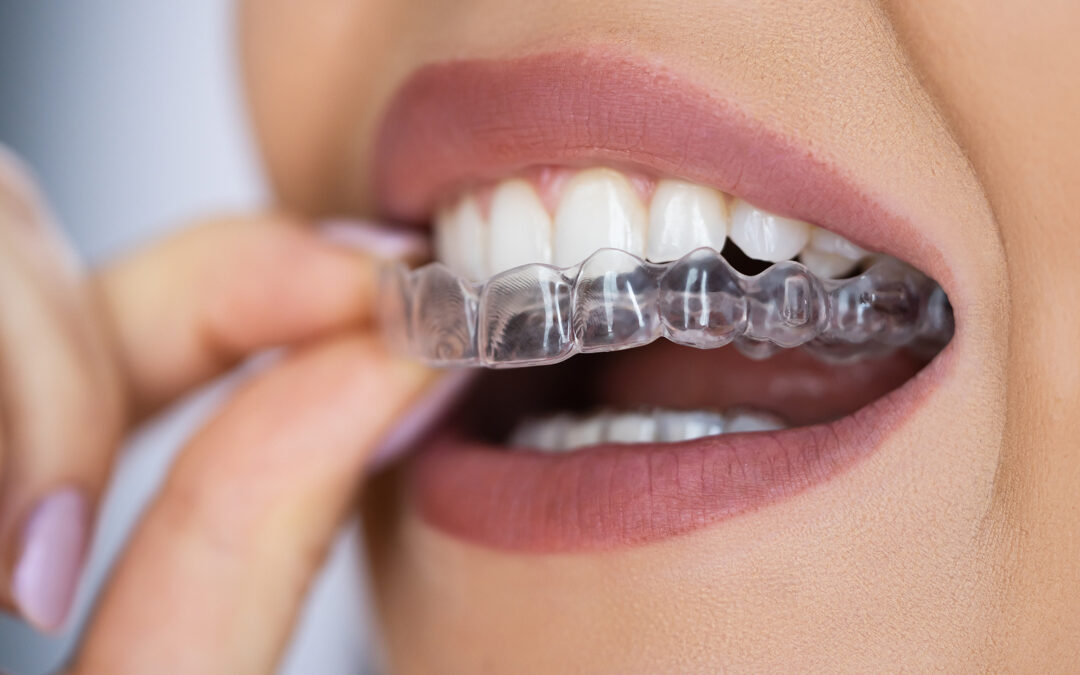 Everything about Invisalign® invisible braces