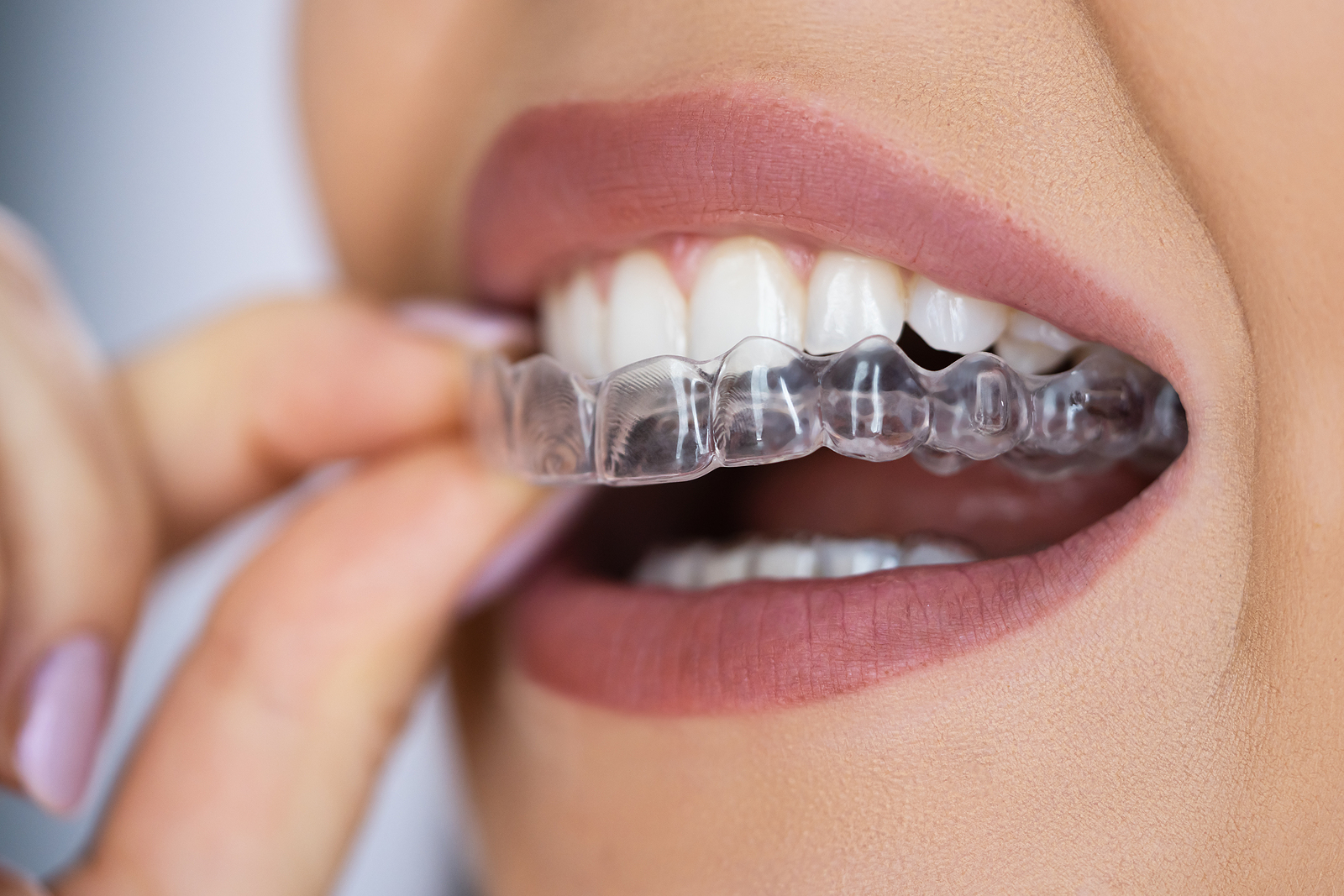 https://hovedentalclinic.co.uk/wp-content/uploads/2022/12/bigstock-Clear-Aligner-Dental-Night-Gua-463488851.jpg?utm_source=chatgpt.com