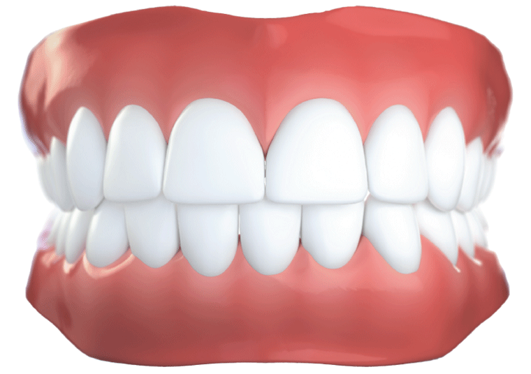 invisalign before after
