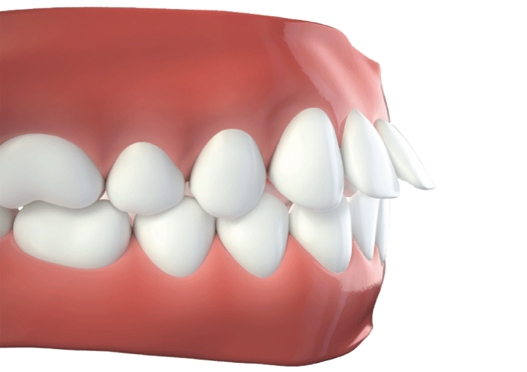 invisalign before after