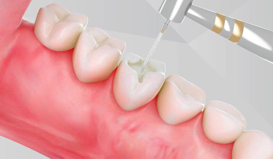 Treatment Preview Image