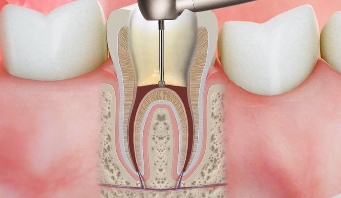 Treatment Preview Image